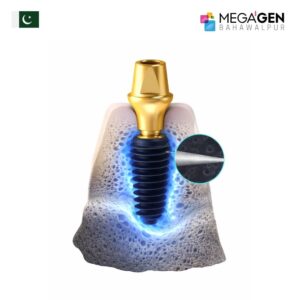 AnyRidge Implant