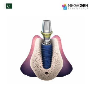 AnyOne Implant