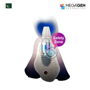 Megagen BD Cuff Dental Implant in Pakistan