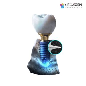 Megagen Blue Diamond Dental Implant